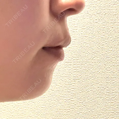 ボトックス（あご） ルラ美容クリニック 上野院 AFTER