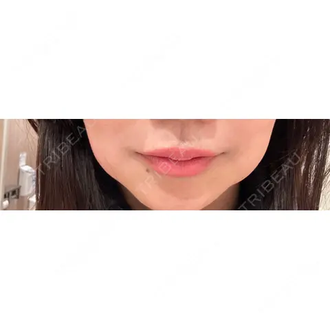 脂肪溶解注射（顔） BELINDA CLINIC（ベリンダクリニック）岡山院 DAY 0