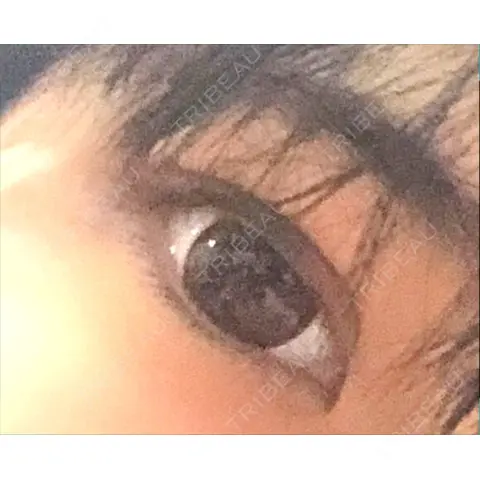 二重切開 アロマ美容外科クリニック AFTER