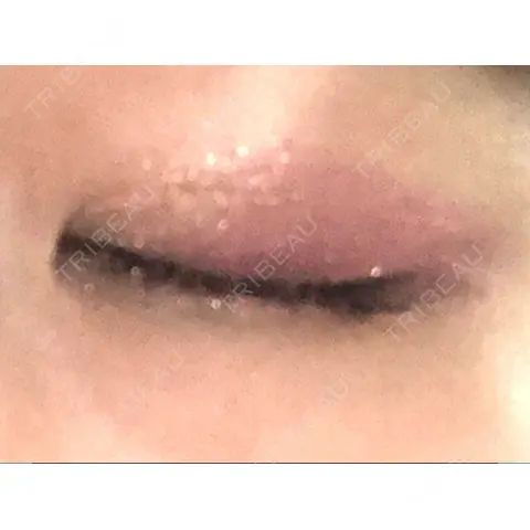 二重切開 アロマ美容外科クリニック AFTER