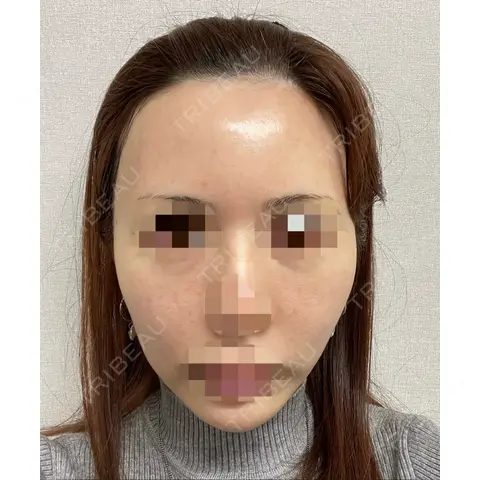 水光注射（ハリ・美肌） LIAN clinic【リアンクリニック】 AFTER