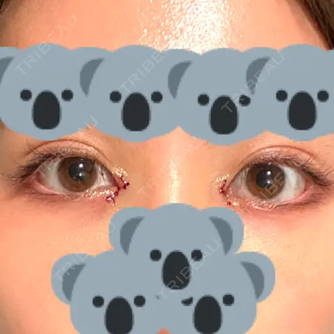 目頭切開 AI Beauty Clinic （エーアイ美容クリニック） DAY 0