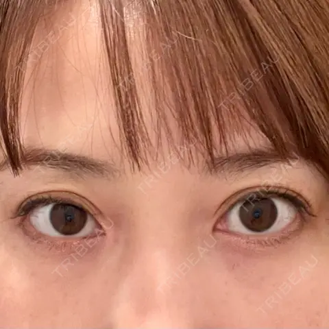 クマ治療 X CLINIC 銀座院 AFTER