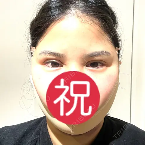 二重埋没 / 糸リフト / 脂肪吸引（顔） / ヒアルロン酸注入（涙袋） / ピアス穴あけ ルラ美容クリニック 大阪本院 DAY 0