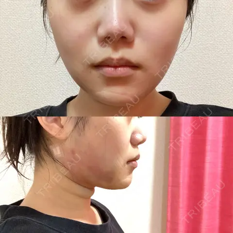 糸リフト / 脂肪吸引（顔） / ボトックス（エラ・小顔） RIVER CLINIC（リバークリニック） DAY 0