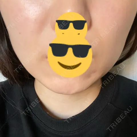ヒアルロン酸注入（鼻翼基部） ルラ美容クリニック 広島院 AFTER