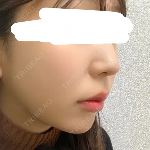 糸リフト / バッカルファット除去 / 脂肪吸引（顔） / メーラーファット除去 / ボトックス（あご） / ヒアルロン酸注入（あご） DIVINE（ディバイン）整形外科 AFTER