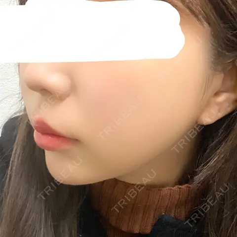 糸リフト / バッカルファット除去 / 脂肪吸引（顔） / メーラーファット除去 / ボトックス（あご） / ヒアルロン酸注入（あご） DIVINE（ディバイン）整形外科 AFTER