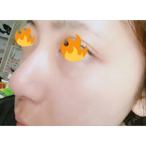 レディエッセ注入（鼻） トアロード形成美容クリニック AFTER