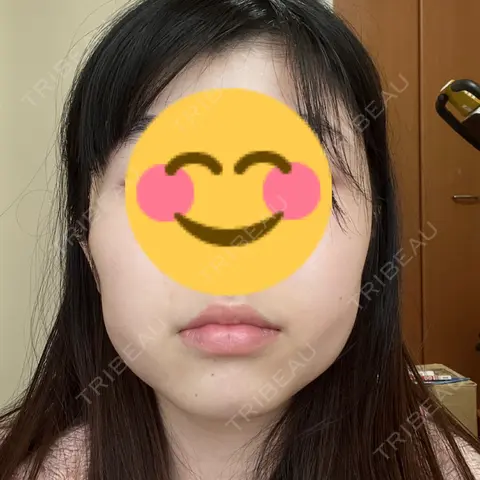 脂肪吸引（顔） / ボトックス（エラ・小顔） Mods Clinic（モッズクリニック） 大阪院 DAY 27