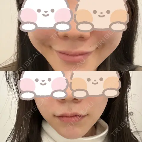 糸リフト / バッカルファット除去 RIVER CLINIC（リバークリニック） DAY 0
