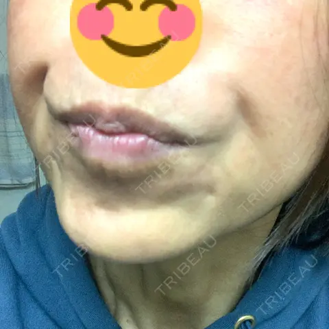 ボトックス（あご） / ボトックス（エラ・小顔） / ボトックス（首） ルラ美容クリニック 千葉院 AFTER