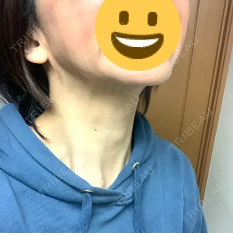ボトックス（あご） / ボトックス（エラ・小顔） / ボトックス（首） ルラ美容クリニック 千葉院 AFTER