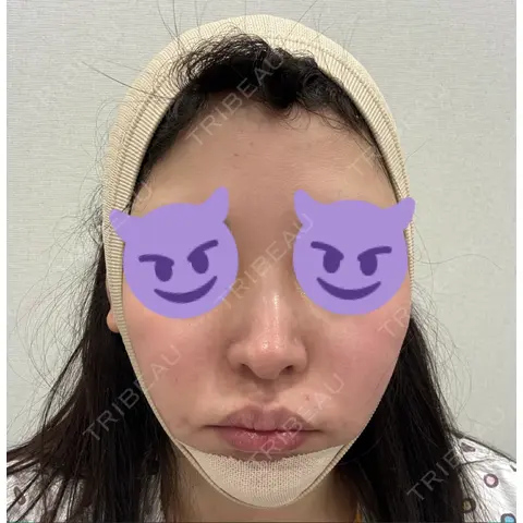 あご下筋肉縛り / その他（輪郭） 21美容外科医院 DAY 0