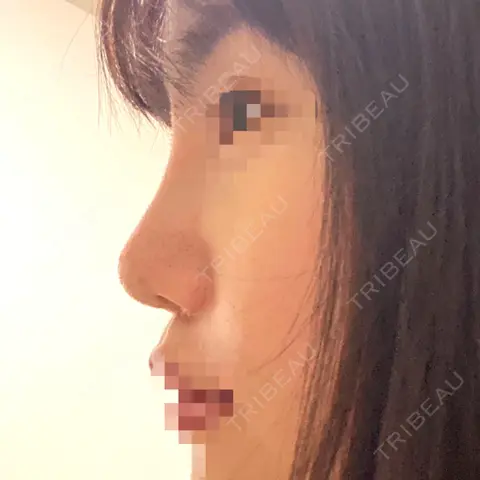 隆鼻術 / 鼻尖形成（切開） / 軟骨移植 / 骨切幅寄せ / 眉間プロテーゼ LUHO（ルホ）美容外科 DAY 34