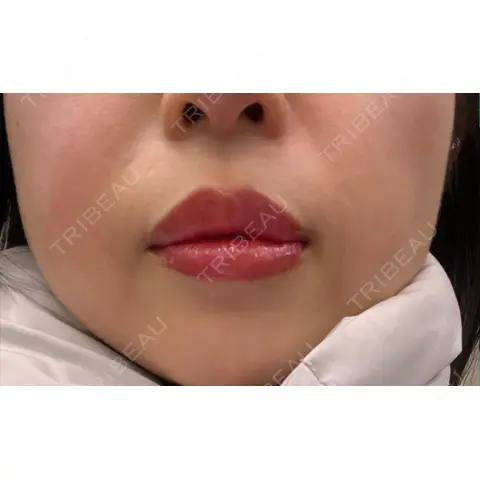 アートメイク（唇） Kinshicho Beauty Clinic （錦糸町ビューティークリニック） DAY 0