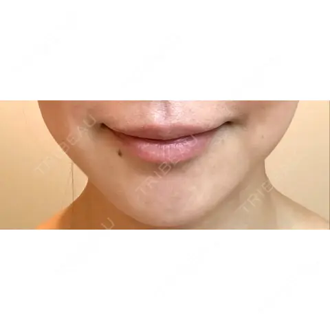 脂肪溶解注射（顔） BELINDA CLINIC（ベリンダクリニック）岡山院 AFTER