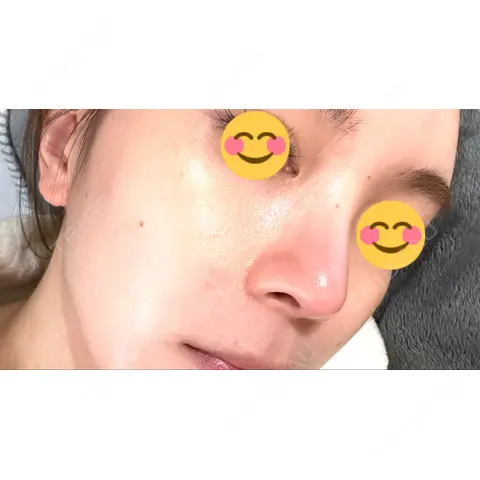 ヒアルロン酸注入（鼻翼基部） 銀座美容外科クリニック 新宿院 AFTER