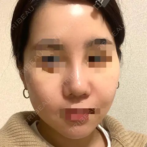 隆鼻術 / 鼻尖形成（切開） / 軟骨移植 / 骨切幅寄せ / 眉間プロテーゼ LUHO（ルホ）美容外科 AFTER