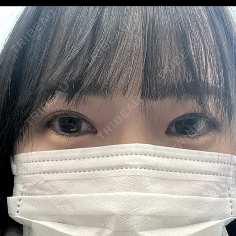 ヒアルロン酸注入（涙袋） 東京皮膚科・形成外科 (銀座いけだクリニック) AFTER