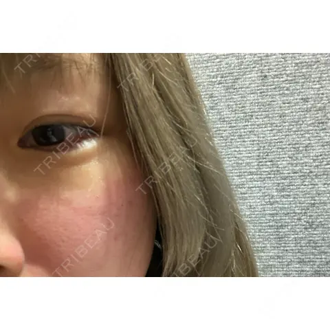 ダーマペン ブリリアスキンクリニック DAY 0