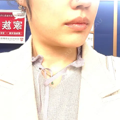 ボトックス（エラ・小顔） / ボトックス（肩） / シワ取りボトックス / ボトックス（首） THE FIRST CLINIC 多摩センター院 AFTER