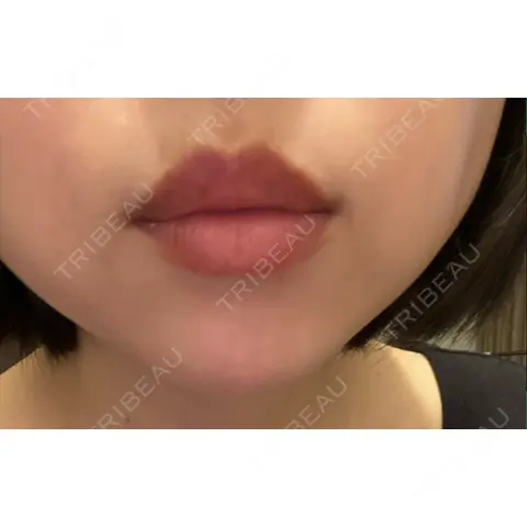 アートメイク（唇） Kinshicho Beauty Clinic （錦糸町ビューティークリニック） AFTER