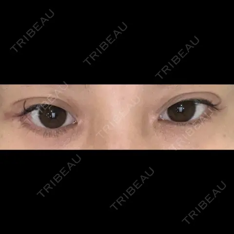 目頭切開 / クマ治療 / 目尻切開 / タレ目形成・グラマラスライン（切開） 銀座TAクリニック AFTER
