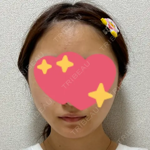 糸リフト / ボトックス（エラ・小顔） TCB東京中央美容外科 仙台駅前院 DAY 0