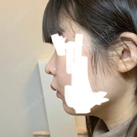 鼻尖形成（切開） / 軟骨移植 MIL CLINIC OSAKA AFTER