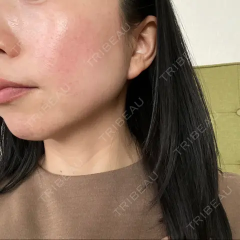 エレクトロポレーション しらゆりメディカルクリニック （旧しらゆりビューティークリニック） AFTER