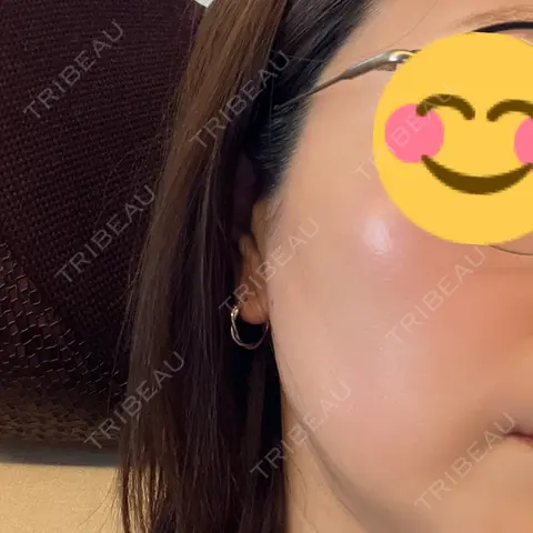ボトックス（エラ・小顔） 新未来クリニック AFTER