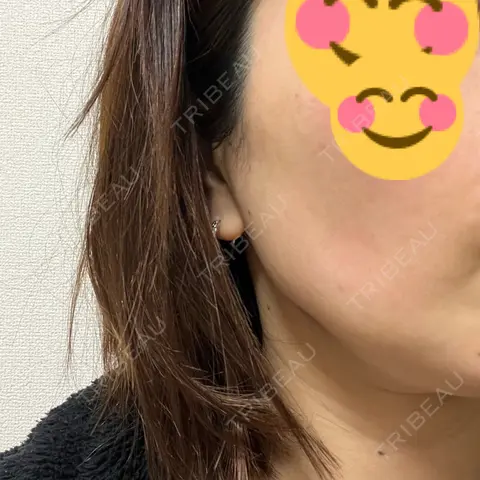 ボトックス（エラ・小顔） 新未来クリニック AFTER