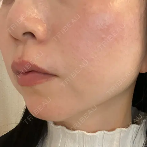 エレクトロポレーション しらゆりメディカルクリニック （旧しらゆりビューティークリニック） AFTER