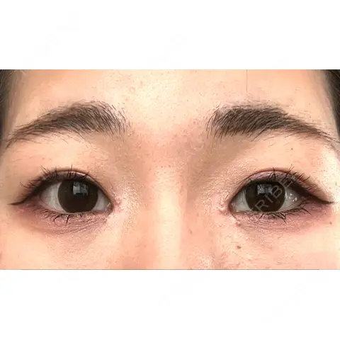 目頭切開 AI Beauty Clinic （エーアイ美容クリニック） AFTER