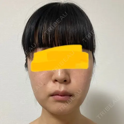 インディバ（顔） WOM SALON【術後ケア取扱いサロン】 AFTER