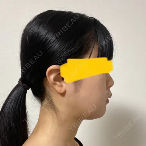 インディバ（顔） WOM SALON【術後ケア取扱いサロン】 AFTER