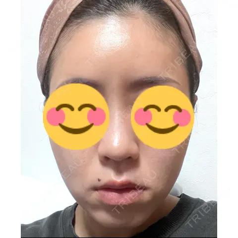 糸リフト / ボトックス（あご） 東京美容外科 熊本院 DAY 0