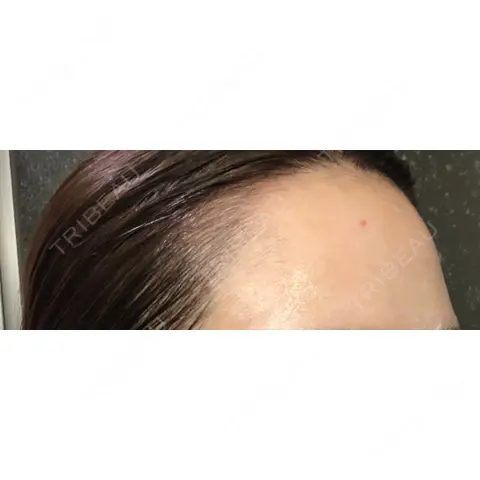 アートメイク（ヘアライン） Tokyo Tensei Clinic 新宿院 AFTER