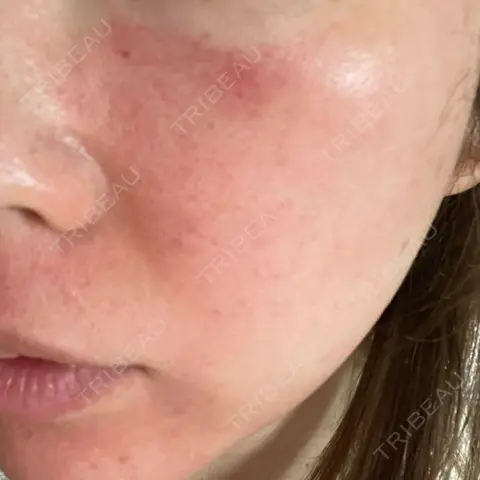 ヴェルヴェットスキン ブリリアスキンクリニック AFTER