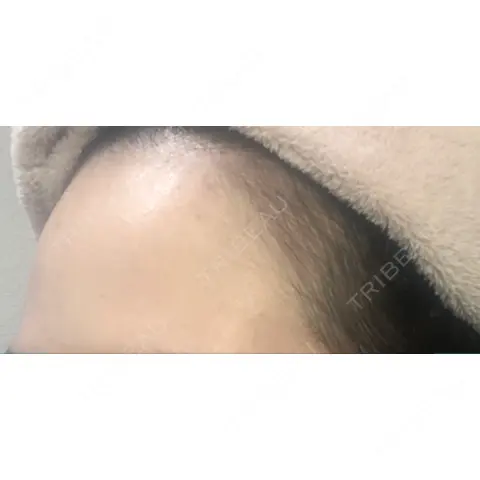 アートメイク（ヘアライン） Tokyo Tensei Clinic 新宿院 AFTER