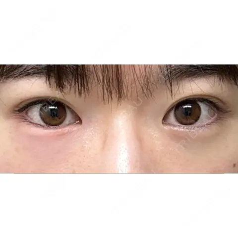 ヒアルロン酸溶解 麻布十番クレールデンタルクリニック DAY 0