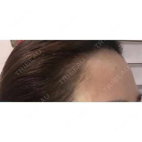アートメイク（ヘアライン） Tokyo Tensei Clinic 新宿院 AFTER