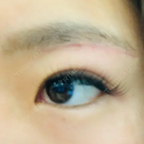 上まぶたの脂肪取り / 眉下切開 THE FIRST CLINIC 多摩センター院 AFTER