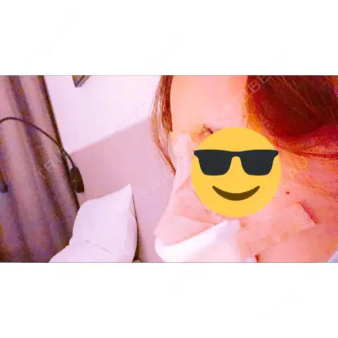 隆鼻術 / 軟骨移植 / 骨切幅寄せ id（アイディ）美容外科 DAY 1
