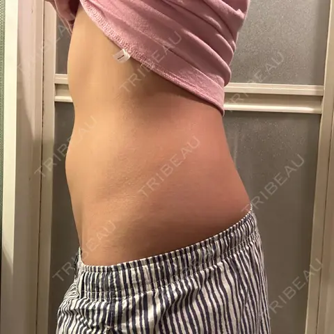 医療痩身（お腹） 湘南美容クリニック 博多院 AFTER