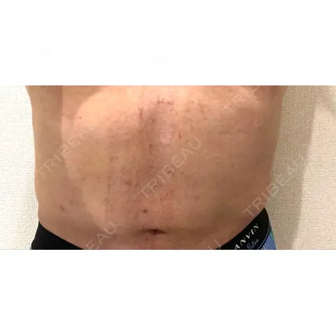 脂肪吸引（お腹） WOM CLINIC GINZA （ワム クリニック ギンザ） AFTER