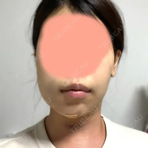 糸リフト / 脂肪吸引（顔） / ジョールファット除去 / ボトックス（エラ・小顔） アリエル美容クリニック 大宮院 DAY 1