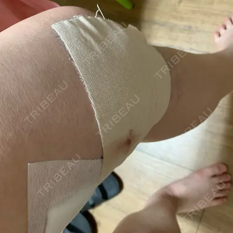 脂肪溶解注射 カイ整形外科・皮膚科 DAY 0