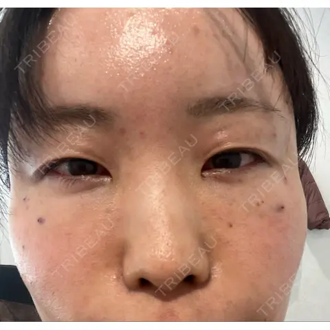 クマ治療 / こめかみ形成 / 脂肪注入（額） / 脂肪注入（目の下） / ボトックス（額） X CLINIC 銀座院 DAY 0